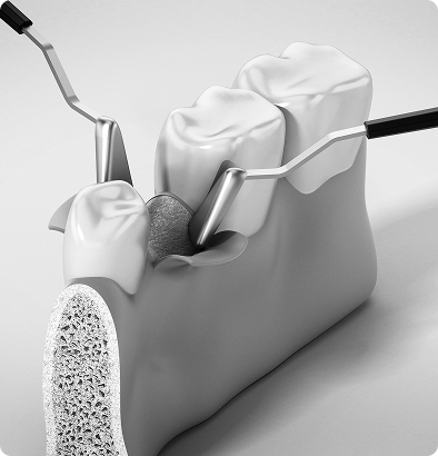 Chirurgies des gencives & greffes gingivales Chirurgies des gencives & greffes gingivales