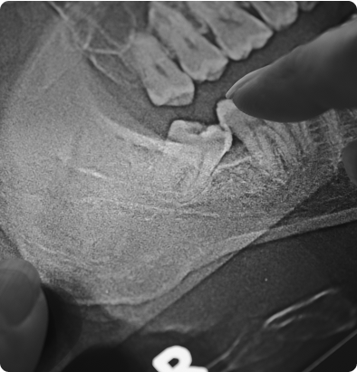 Extraction des dents de sagesse Extraction des dents de sagesse