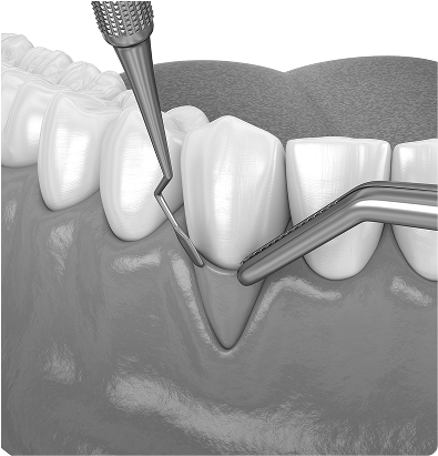 Greffes de gencive : protéger les dents, préserver le sourire