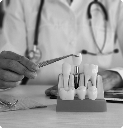 Implants dentaires Implants dentaires