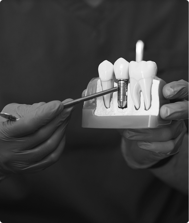 Qu’est-ce qu’un implant dentaire ? Qu’est-ce qu’un implant dentaire ?