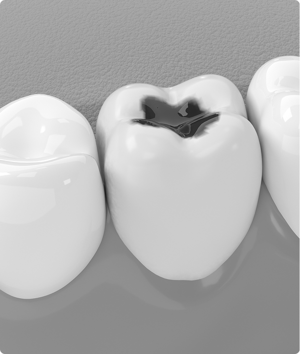 Qu’est-ce qu’une carie dentaire ? Qu’est-ce qu’une carie dentaire ?