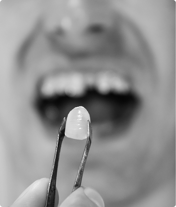 Une solution moderne et durable pour remplacer les dents manquantes Une solution moderne et durable pour remplacer les dents manquantes